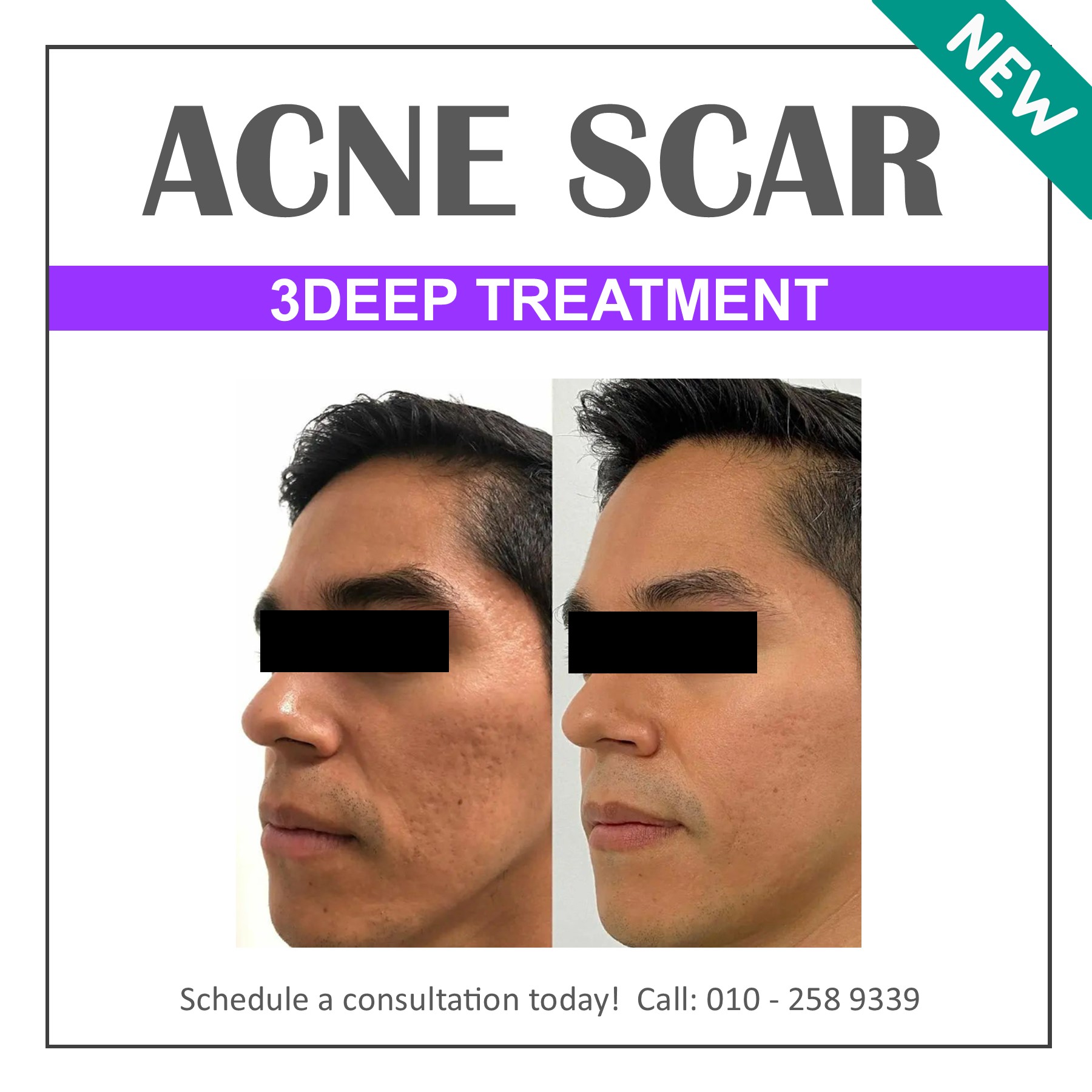 Active Acne & Acne Scar Reduction – Jy Beauty Studio